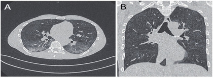 Abb. 1 A+B CT-Thoraxaufnahmen eines spät diagnostizierten Menschen mit HIV: atypische Pneumonie beidseits, mit milchglasartigen Infiltraten (A + B), vor Diagnose und Therapie einer Pneumocystis jiroveci-Infektion