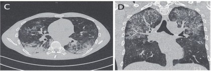 Abb. 3 C+D CT-Thoraxaufnahmen eines spät diagnostizierten Menschen mit HIV, am Tag 18 nach Beginn der Therapie einer Pneumocystis jiroveci-Pneumonie und Tag 8 nach ART-Start und bei nun erneuter klinischer Beschwerdesymptomatik: neue diffuse beidseitige Oberfeld-Infiltrate (C + D)