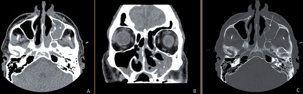 Abb. 2 DCT der Nasennebenhöhlen ohne Kontrastmittel: In der axialen Rekonstruktion (A) zeigt sich eine vollständige Verlegung des linken Sinus maxillaris (Pfeil). In der koronaren Rekonstruktion lässt sich eine umschriebene Weichteilläsion mit erhöhten Dichtewerten (B, Pfeil) abgrenzen. Zudem zeigt sich in Ausspielung des Knochenfensters (C) eine ossäre Destruktion der medialen Wand des Sinus maxillaris