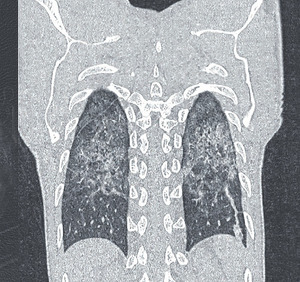 Abb. 1   Pneumocystis jirovecii-Pneumonie im CT-Thorax