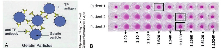 Abb. 1 Funktionsweise des TPPA (A) und Beispiele aus dem Laboralltag (B). (A) Auf Gelatinepartikel aufgebrachte Treponemenantigene binden die bei be- stehender oder durchgemachter Infektion im Patientenblut vorhandenen Antikörper und agglutinieren. (B) Bei Agglutination bilden die Gelatinepartikel einen Teppich, wie bspw. bei dem Titer 1:40 der Patienten 1-3. Wenn keine treponemenspezifischen Antikörper im Patientenblut enthalten sind, sammeln sich die Gelatine- partikel am Boden des Reagenzgefäßes, wie bei dem Titer 1:10240 aller drei Patienten.