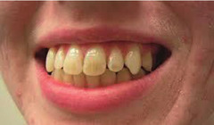 Abb. 3 Doxycycline-Induced staining of Adult Teeth